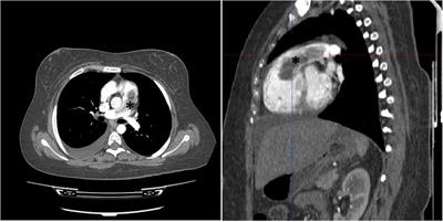 A rare case of myxoma mimicking pulmonary thromboembolism: a case report